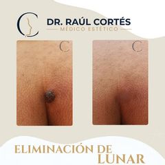 Eliminación Lunar - Dr. Andrés Raúl Cortés Ponce