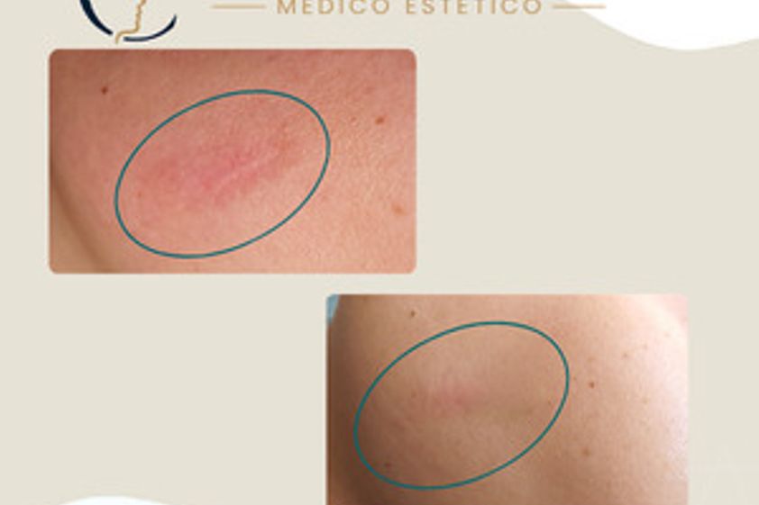 Eliminación de cicatrices antes y después - 880593