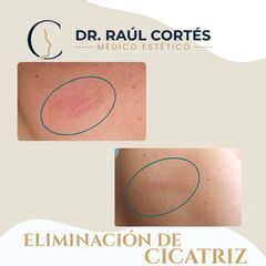 Eliminación Cicatriz - Dr. Andrés Raúl Cortés Ponce