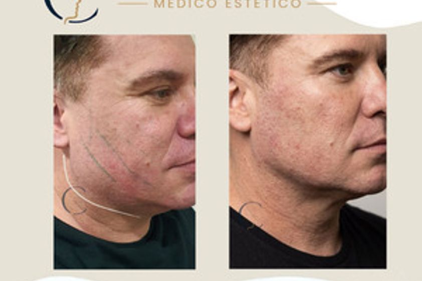 Hilos tensores antes y después - 880594