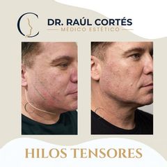 Hilos Tensores - Dr. Andrés Raúl Cortés Ponce