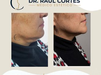 Carboxiterapia antes y después - 880595