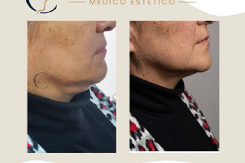 Carboxiterapia antes y después - 880595