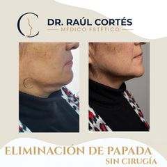 Eliminación Papada - Dr. Andrés Raúl Cortés Ponce