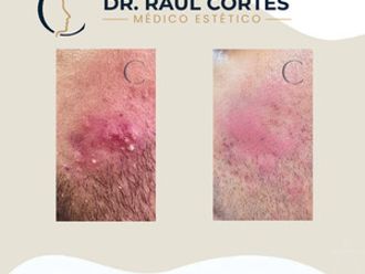 Tratamiento antiacné antes y después - 880596