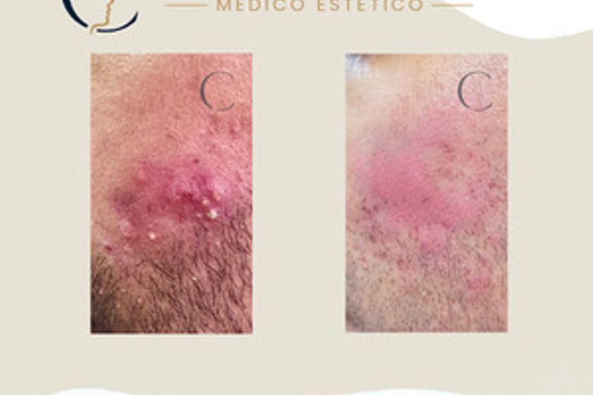 Tratamiento antiacné antes y después - 880596