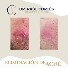 Eliminación Acné -Dr. Andrés Raúl Cortés Ponce