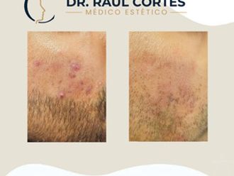 Tratamiento antiacné antes y después - 880597