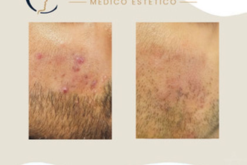 Tratamiento antiacné antes y después - 880597