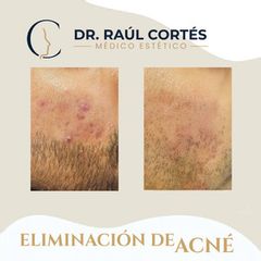 Eliminación Acné - Dr. Andrés Raúl Cortés Ponce