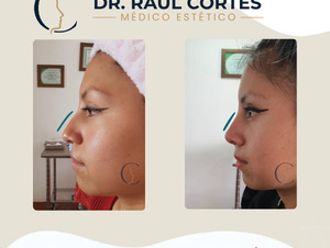 Rinomodelación antes y después - 880598