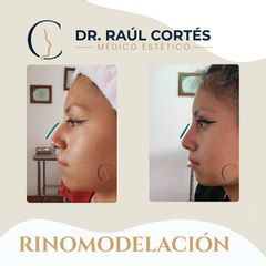 Rinomodelación - Dr. Andrés Raúl Cortés Ponce