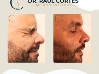 Toxina botulínica antes y después - 880599