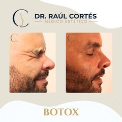 Toxina Botulínica -Dr. Andrés Raúl Cortés Ponce