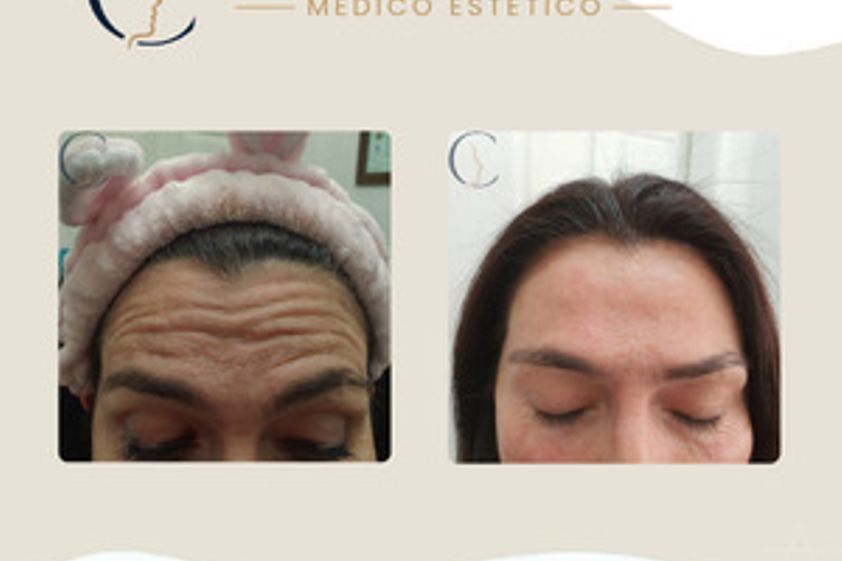 Toxina botulínica antes y después - 880600