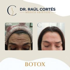 Toxina Botulínica - Dr. Andrés Raúl Cortés Ponce