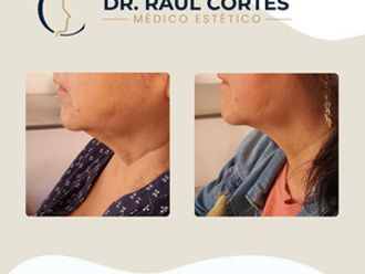Toxina botulínica antes y después - 880601