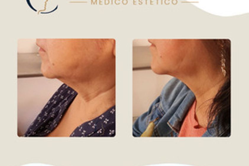 Toxina botulínica antes y después - 880601