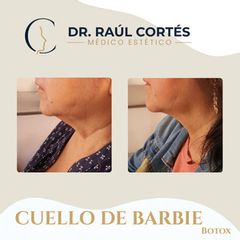 Toxina Botulínica - Dr. Andrés Raúl Cortés Ponce