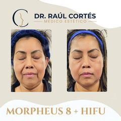 HIFU - Dr. Andrés Raúl Cortés Ponce