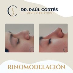 Rinomodelación - Dr. Andrés Raúl Cortés Ponce