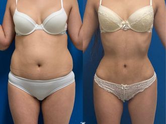 Lipoescultura antes y después - 843381