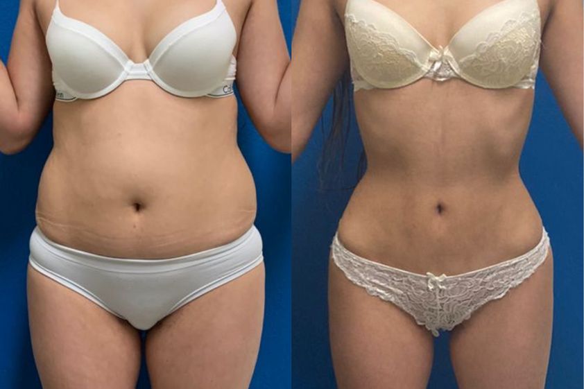 Lipoescultura antes y después - 843381