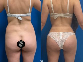 Lipoescultura antes y después - 843382