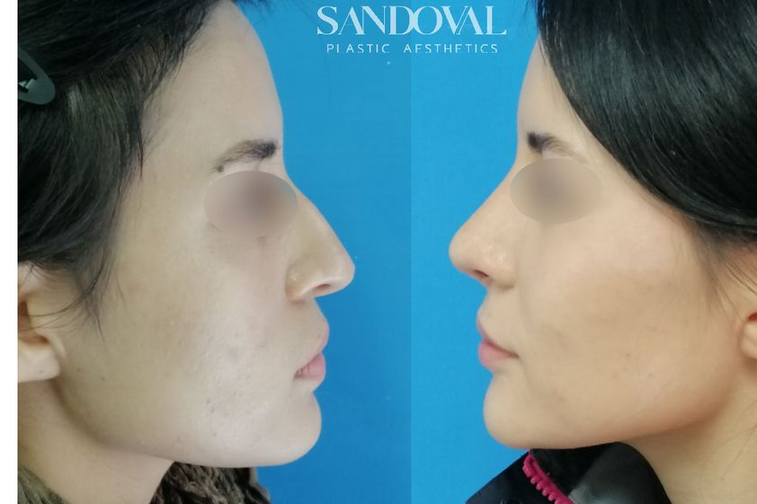 Rinoplastia antes y después - 843383