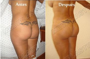 Antes y después de lipoescultura 