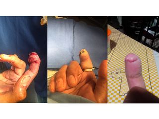 Antes y después de Cirugía plástica reconstructiva