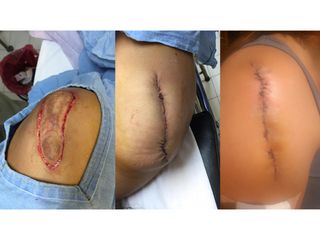 Antes y después de Cirugía para cicatrices