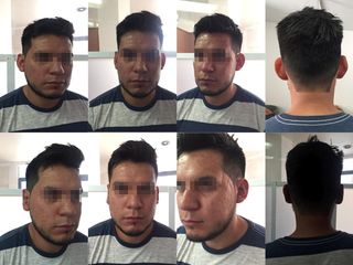 Antes y después de Otoplastia