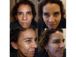 Antes y después Aplicación de toxina botulínica