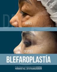 Blefaroplastia - Dr. Francisco Forasté