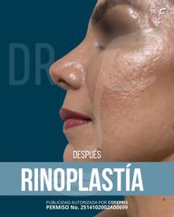 Rinoplastia - Dr. Francisco Forasté