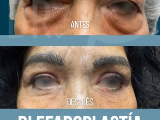 Blefaroplastia antes y después - 878025