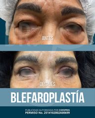 Blefaroplastia - Dr. Francisco Forasté