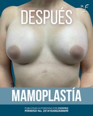 Aumento de busto - Dr. Francisco Forasté