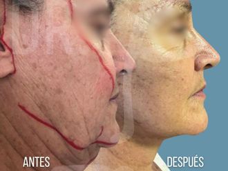 Lifting antes y después - 878027