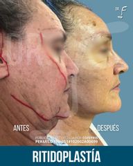 Lifting Facial - Dr. Francisco Forasté