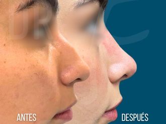 Rinoplastia antes y después - 878028