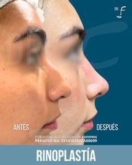 Rinoplastia - Dr. Francisco Forasté