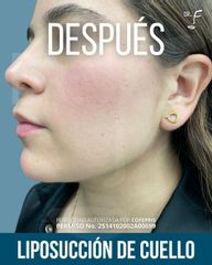 Liposucción de papada - Dr. Francisco Forasté