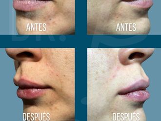 Aumento de labios antes y después - 878032