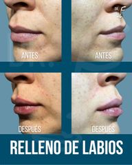Aumento de labios - Dr. Francisco Forasté