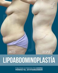 Lipo Abdominoplastia - Dr. Francisco Forasté