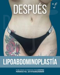 Lipo Abdominoplastia - Dr. Francisco Forasté