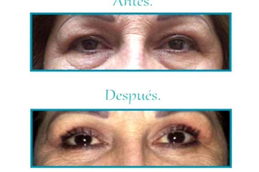 Blefaroplastia antes y después - 639068