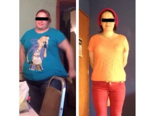 Antes y después de Bypass Gástrico
